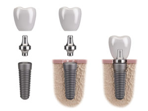 3 Prong Dental Implants Placement Houston