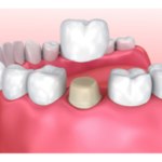 Dental-Crowns Procedure Process