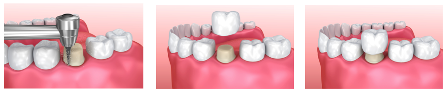 Dental-Crowns Procedure Process