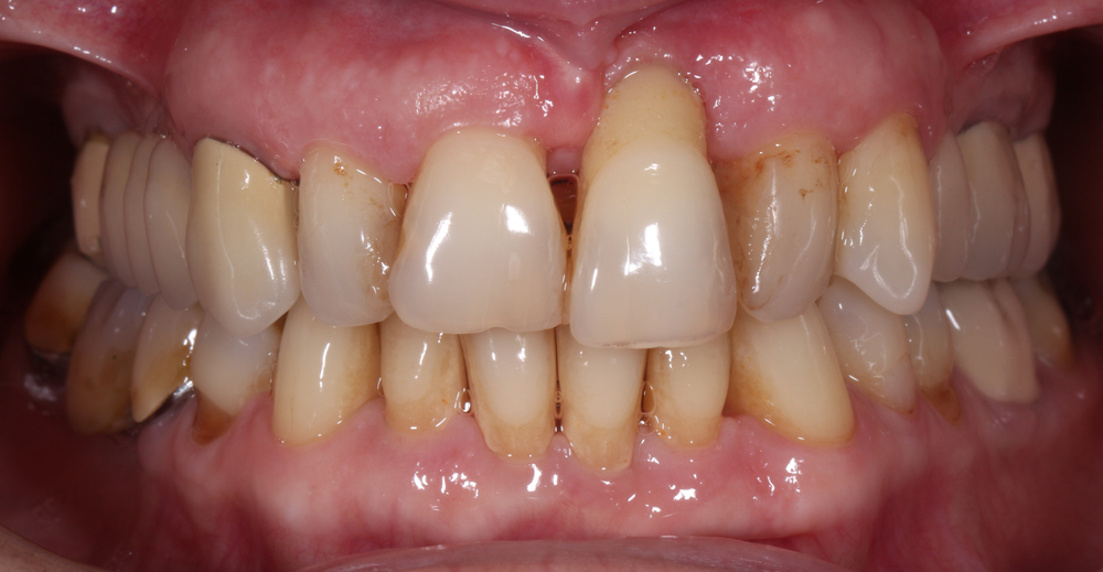 How Do You Fix Gum Recession?
