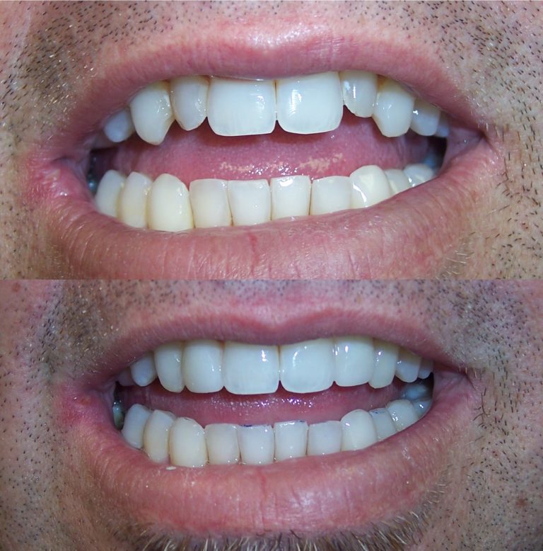Which Smile Problems Can Veneers Fix?