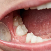 How to Prevent Bone Loss After Tooth Extraction