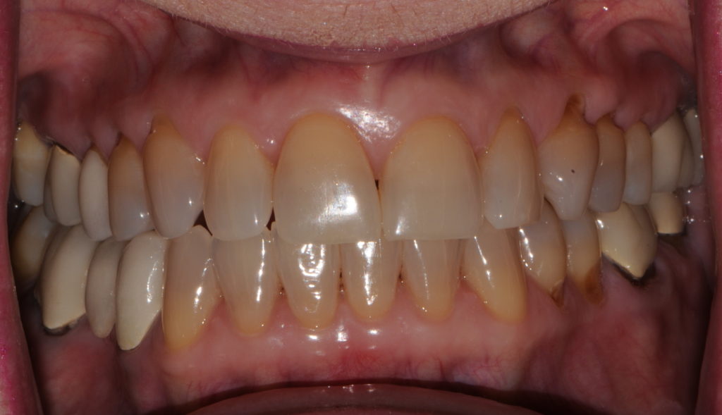 How Can I Treat Deep Stains on My Teeth?