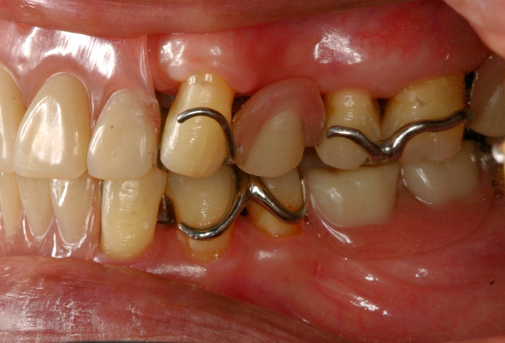 What are My Tooth Replacement Options?