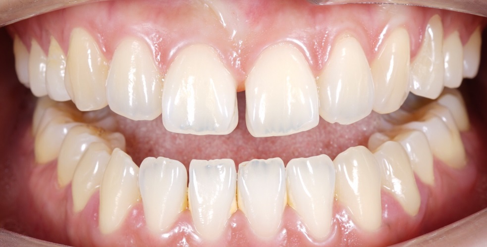 Teeth Bonding For Gaps, Teeth Gap Filling Cost