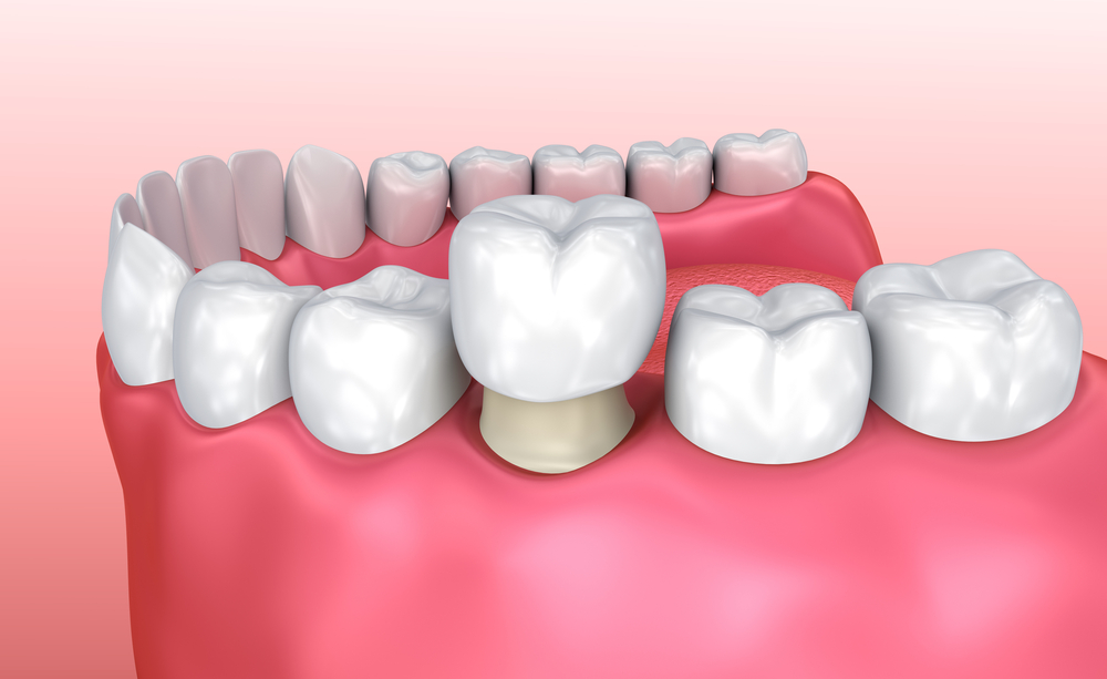Can I Whiten the Appearance of Old Crowns and Other Dental Work?
