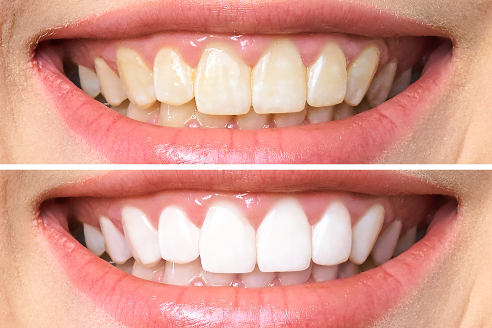 How to Brighten Your Smile: Whitening Fillings on Front Teeth