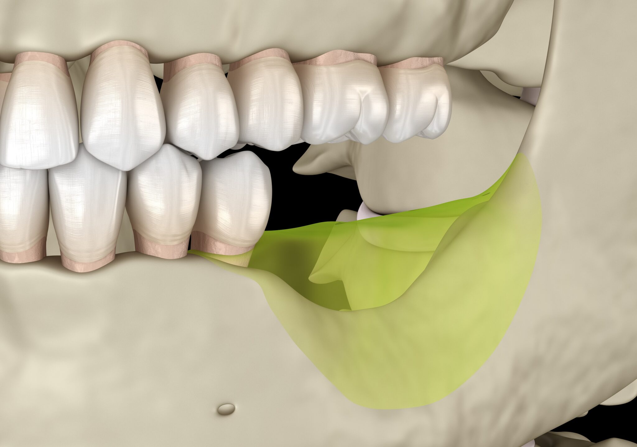 Зуб без кости. Костная резорбция челюсти. Наращивание кости в стоматологии для имплантации. Кость вокруг имплантата зуба.
