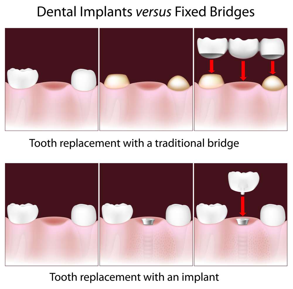 How Does a Dental Bridge Work?