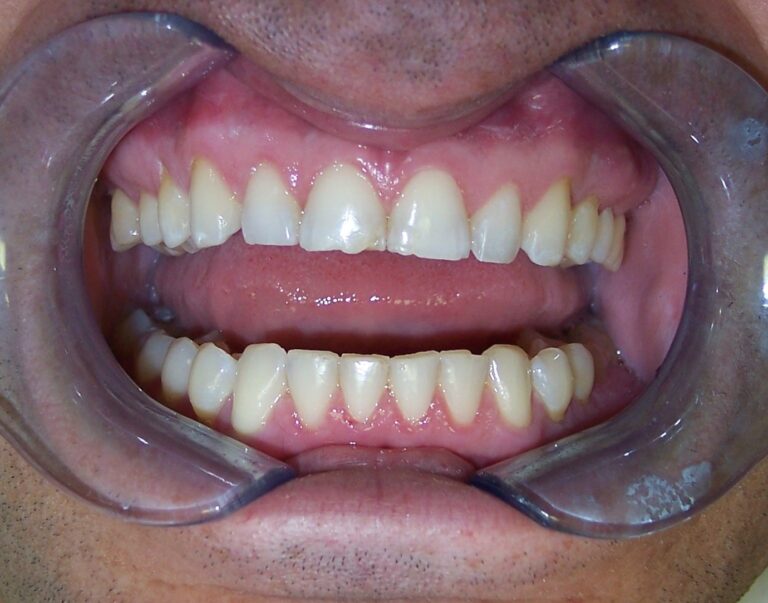 Why Do My Teeth Look So Short?
