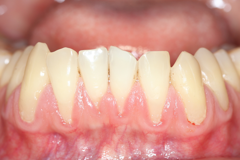 Is Gum Recession Bad For My Dental Health