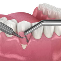 Gingival Recession