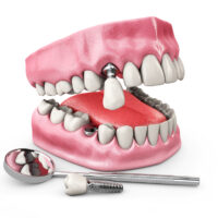 teeth implant