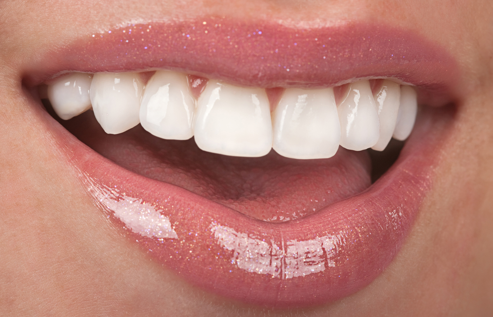 Are Porcelain Veneers Permanent?