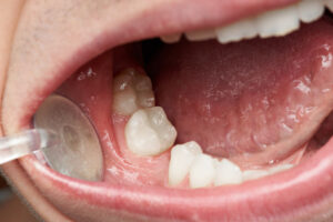 Missing tooth (2)