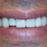 Broken veneer