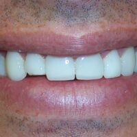 Broken veneer