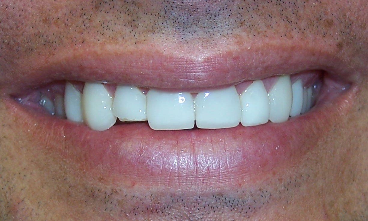 What Happens if I Damage or Lose a Porcelain Veneer?
