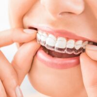 Is Invisalign® Treatment Faster Than Traditional Braces?