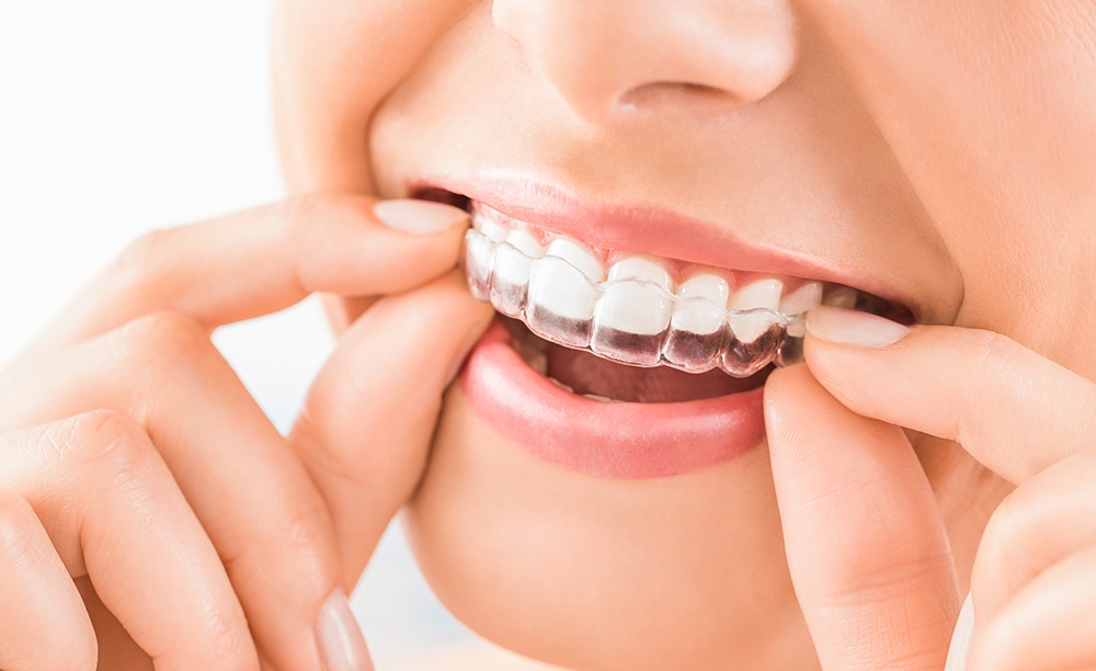 Is Invisalign Treatment Faster Than Traditional Braces?