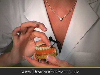 https://www.designerforsmiles.com/wp-content/uploads/video/Veneers-ClearLakeTexas-Designerformsmiles